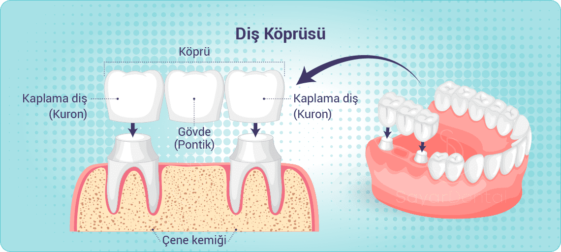 Kendi dişlerinizin üzerine köprü diş nasıl yapılır