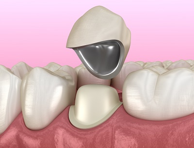 Kendi dişinizin üzerine porselen diş kaplama nasıl yapılır